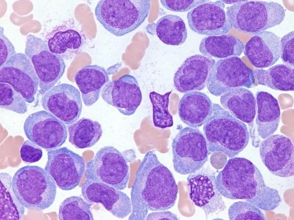 白血病細胞を殺す新しい化合物を発見。ミトコンドリアを標的とした化学療法の可能性を示す。