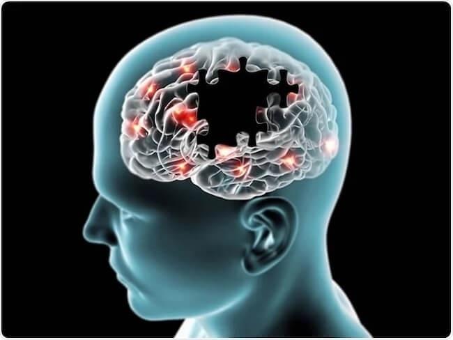 腸内環境が悪い人は、アルツハイマー病の発症リスクが高い可能性。早期発見と新たな治療法につながる世界初の研究。