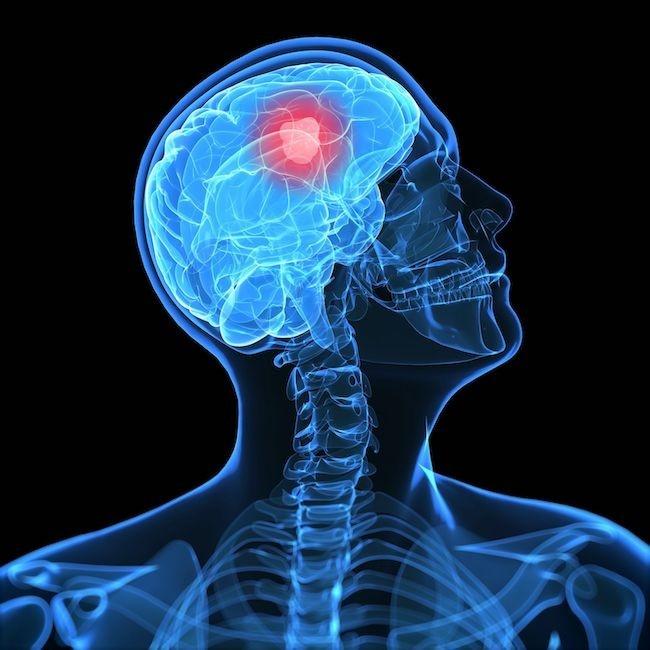 正常な脳細胞から神経膠芽腫細胞への進化を研究。新たな抗癌剤標的の発見にも期待。