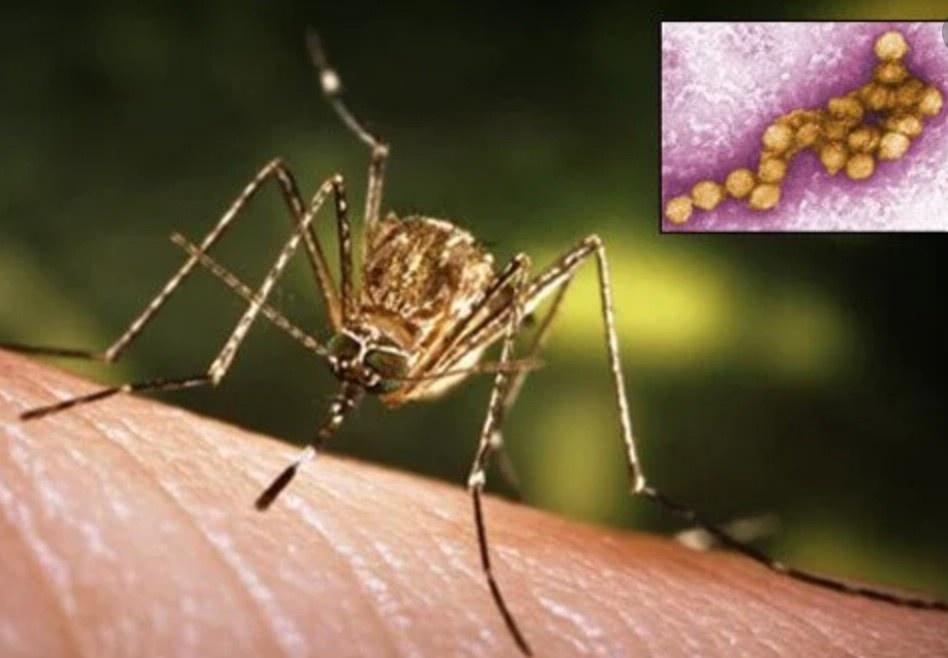ウエストナイル感染での致命的症状、抗インターフェロン自己抗体が影響
