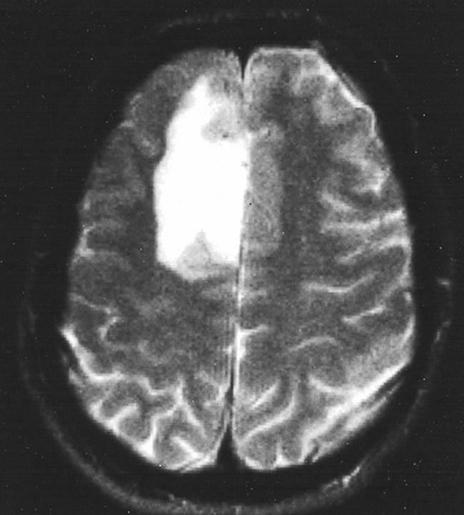 手術中に脳腫瘍のDNA解読可能なAIツール:最新研究結果が学術誌に掲載