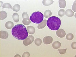Sloan-Ketteringでのターゲット細胞をベースにした免疫療法で死亡率の高い白血病患者5人が完全に寛解