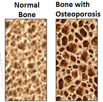 骨粗鬆症における骨破壊を排除するための潜在的な細胞ターゲットが特定された
