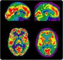 ティーンエイジャーの薬物乱用は脳内ネットワークに起因―大規模臨床研究で明らかに