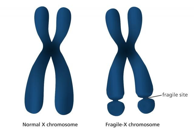 ヒト幹細胞における脆弱X症候群の抑制されたFMR1遺伝子を再活性化するCRISPRツール