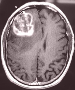 膠芽腫は脳損傷後の治癒過程が関与している可能性があるとシングルセル技術を用いた新研究が示唆
