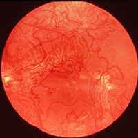 網膜血管新生症のアンチセンスオリゴ新薬の候補
