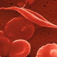 遺伝子導入法による鎌状赤血球症の治療が、現実性を帯びてきた