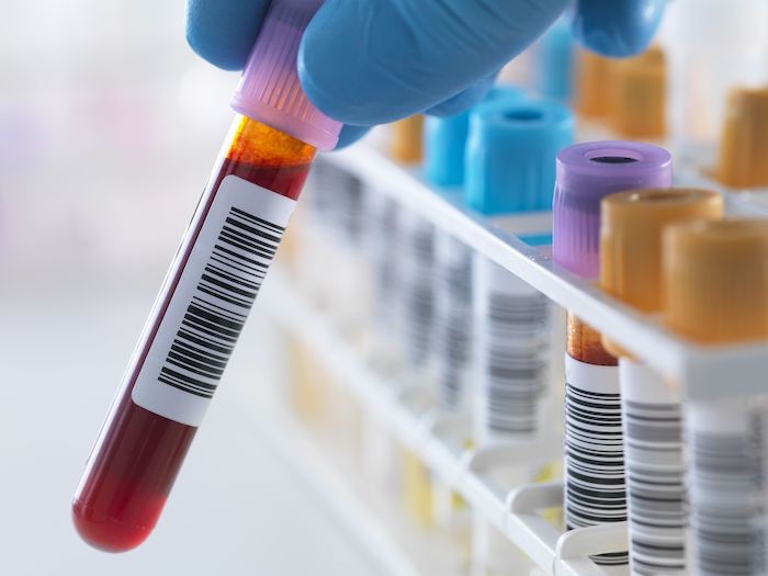 前立腺がん診断の未来：血液ベースの液体生検の臨床的意義