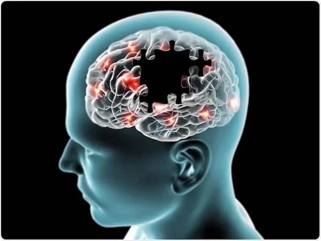 腸内環境が悪い人は、アルツハイマー病の発症リスクが高い可能性。早期発見と新たな治療法につながる世界初の研究。