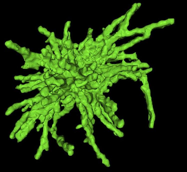 ハンチントン病の細胞障害メカニズムを解明—毒性タンパク質凝集体が核膜を破壊しDNAに損傷を与える