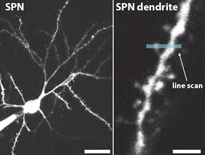 ハンチントン病の発症はDNA拡大が鍵:最新研究が解明する神経変性のメカニズム