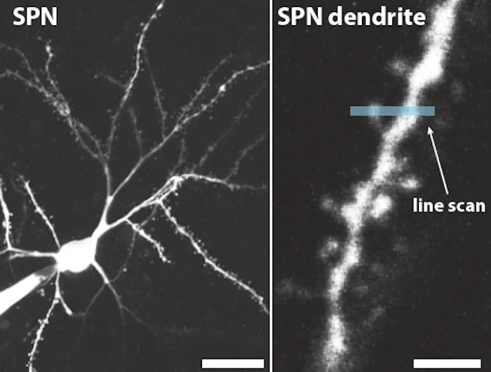 ハンチントン病の発症はDNA拡大が鍵：最新研究が解明する神経変性のメカニズム