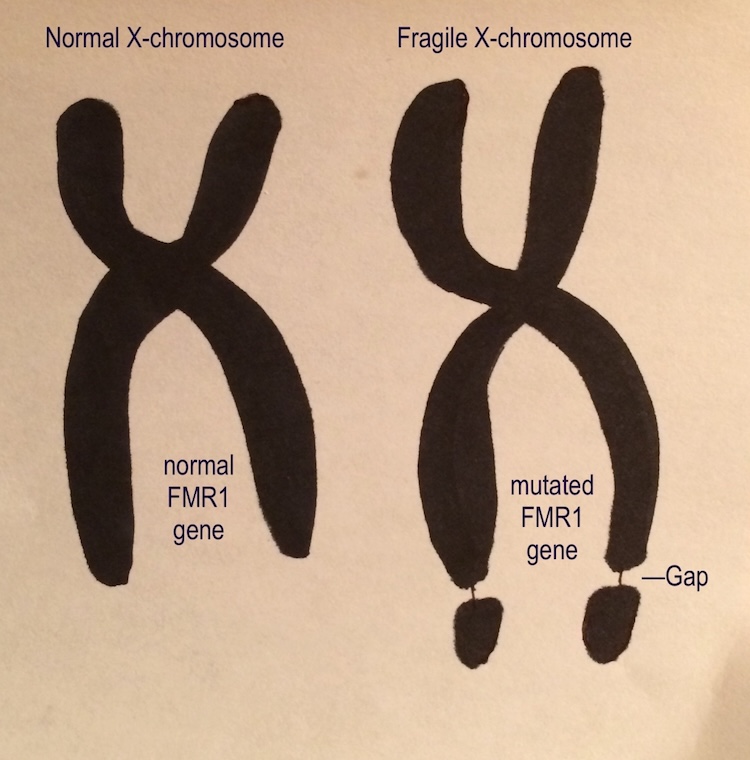 脆弱X症候群に新たな治療の光!MITがNMDA受容体サブユニット標的で症状改善