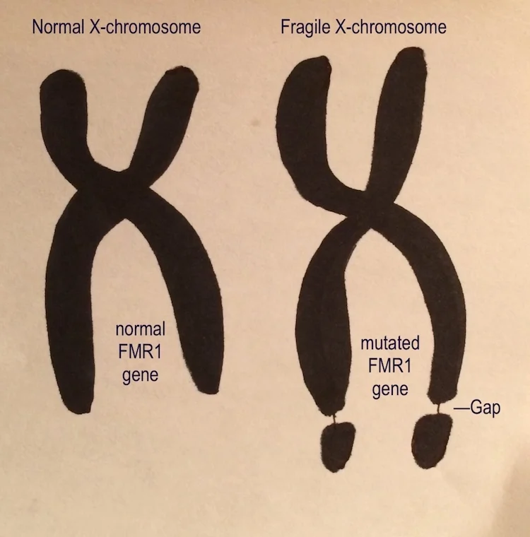 脆弱X症候群に新たな治療の光！MITがNMDA受容体サブユニット標的で症状改善