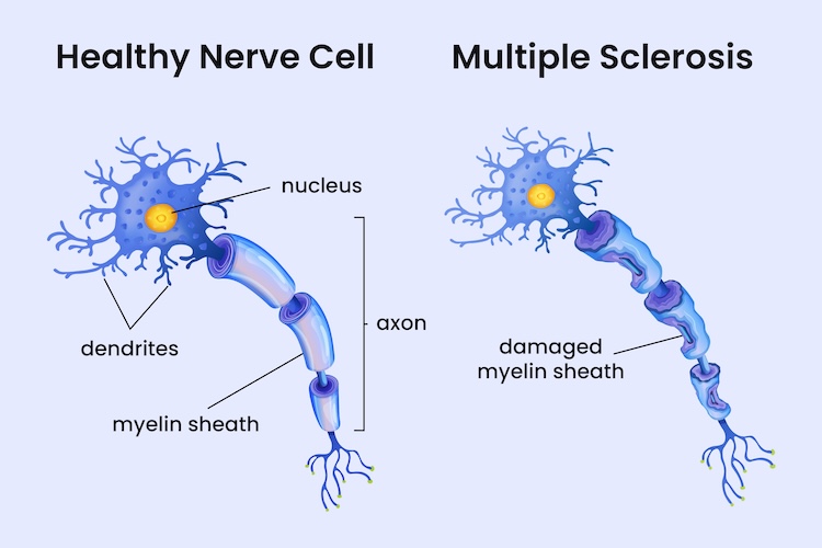 iPS細胞から神経を再生？人工誘導神経幹細胞による脳修復メカニズムが解明