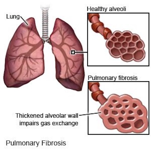 致死的な肺線維症、原因となる「細胞スイッチ」IRE1αの阻害にマウスで成功