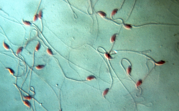 遺伝性男性不妊（NOA）治療に新展開：mRNA送達技術で精子形成を回復