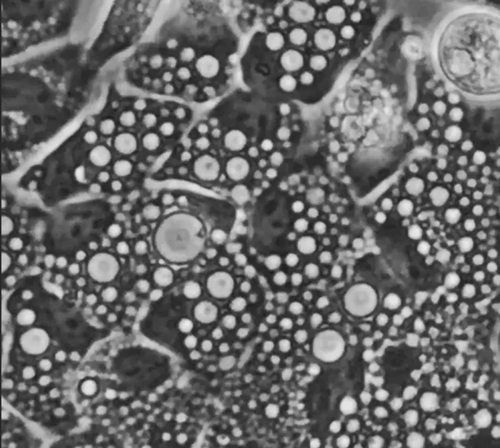 細胞の「ゴミ処理工場」リソソームが異常に膨らむ謎を解明