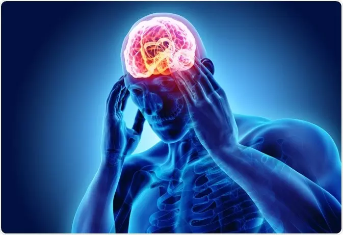 偏頭痛に関する過去最大規模の遺伝子研究により、新たな遺伝的危険因子が判明