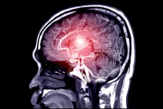 過剰に興奮した神経細胞を鎮静化することで、脳卒中後の脳を保護する可能性が判明。脳卒中による脳損傷に関する数十年来の説に再考を促す新データ。