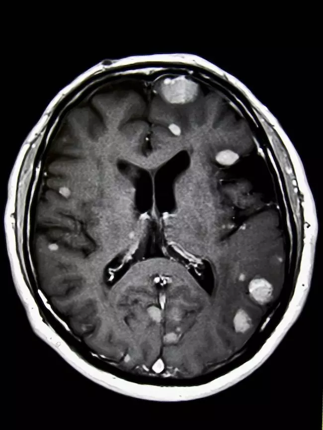 メラノーマの脳転移に関する新たな知見がCell誌に掲載された