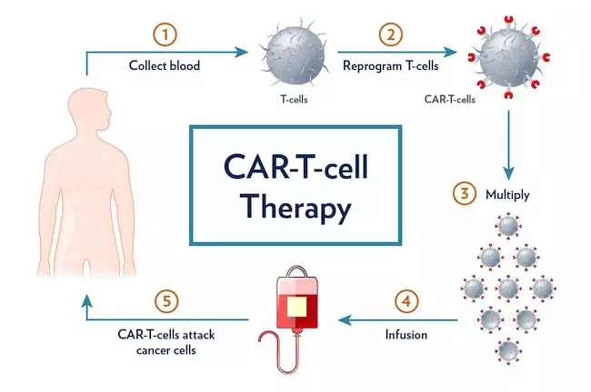 CAR T細胞療法の影響を拡大：ほぼすべての血液がんに効果を持つかもしれない免疫療法